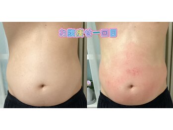 ホワイティアビシェル 浦和(Whitia Vishell)/お腹集中施術!1回変化