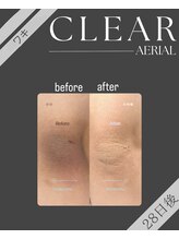 エアリアル 玉名店/ワキの黒ずみケアCLEAR