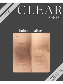 エアリアル 玉名店/ワキの黒ずみケアCLEAR