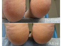 カシェット 広島店(Cachette)/50代女性☆足裏角質ケア90分