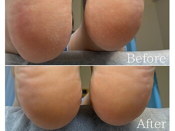 カシェット 広島店(Cachette)/50代女性☆足裏角質ケア90分