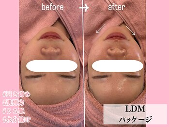 エンクリニカルラボ 京都駅前店(E&N CLINICAL LABO)/美肌小顔のW照射/LDMパッケージ