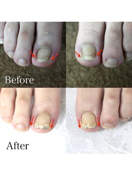 【巻き爪矯正】3回目