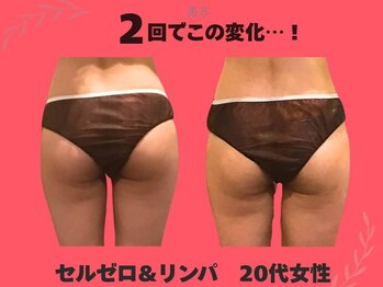 美方/マシーン&リンパで全身痩身に◎