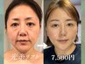 【人気No.1】小顔・リフト・ハリ艶を網羅★光糸リフトで劇的変化◎ ¥15180→
