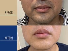 ロペス(Lopez)/【ヒゲ脱毛】15回施術例