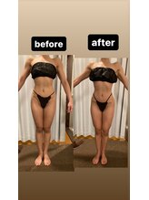 アヌヘア(Anuhea)/インディバ痩身