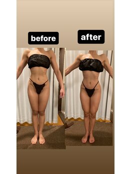 アヌヘア(Anuhea)/インディバ痩身