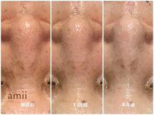 アミィ(amii)/毛穴ケア