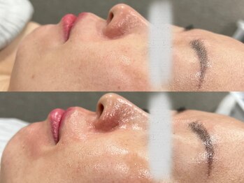 あすはれ/ララピールでハリツヤUP!