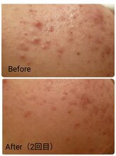 サロン スムース(Salon SMOOOTH)/光フェイシャル1回目比較