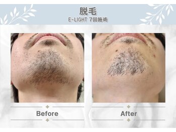 モードケイズ eau 摂津本山店(MODE K's)/ひげ脱毛