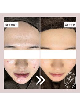 ハルミ 美容整体 新宿店(Harumi)/肌質改善！