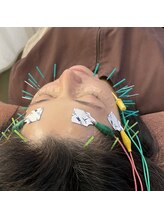 蒼月(aotsuki)/電気を流す美容鍼