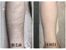 【脱毛救済】＝男女OK＝全身脱毛(VIOなし・顔なし)5,980円