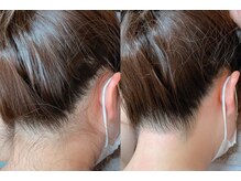 オーガスト(August)/うなじWax &光脱毛　ダブル脱毛