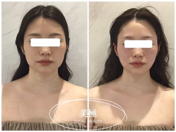 美極 銀座店/銀座/小顔コルギ/小顔矯正