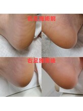 ドクターネイル爪革命 長野店/【角質ケア】リラク/足裏