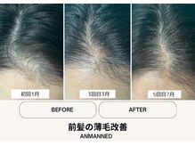 アンマンドの雰囲気（ヒト幹細胞導入で毛量アップ！前髪の透け感が改善）