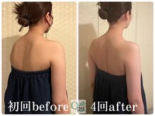 キュープ 福岡天神店(Qpu)/巻き肩コース４回での変化