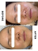 ブロッサム(Blossom)/ホワイトスノーピール8回目