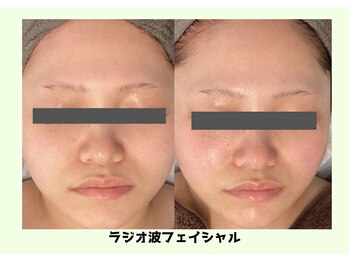 バベルトータルビューティー 北堀江店(Babel Total Beauty)/ラジオ波フェイシャル