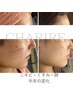 【下まで見てくれた方限定】肌質改善ハーブピーリング+小顔矯正!100分体験