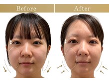 ドクターボディ 自由が丘店(Dr.Body)の雰囲気(【頬の位置UP/フェイスラインの引き締め・左右差解消/目の開き】)