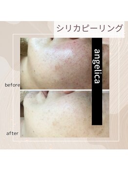 アンジェリカ(Angelica)/シリカピーリング