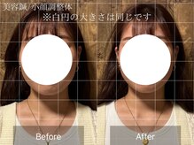 アポヨ鍼灸院(APOYO鍼灸院)/美容鍼　before/after