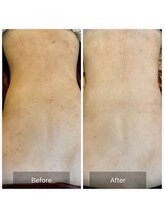 ビビ(VIVI)/背中ニキビケアハーブピーリング