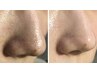 【いちご鼻徹底改善】wax脱毛×毛穴洗浄