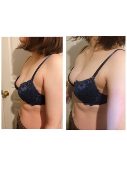 ラポッシュ(La poche)/バストアップ症例写真