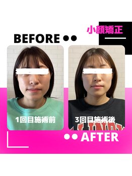 はりん美鍼灸/小顔矯正 第一弾 1