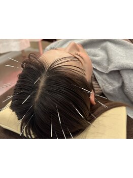 鍼灸施術を受けたい