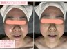 【フェイシャルで迷ったらコレ】人気No3♪肌タイプ別フェイシャルエステ