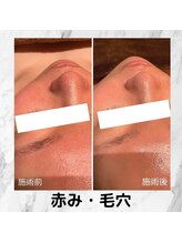 チェンジ(Change)/赤み・毛穴