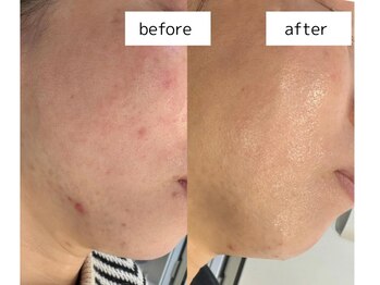 ハクビ(HAKUBI)/マーメイドセルトリートメント