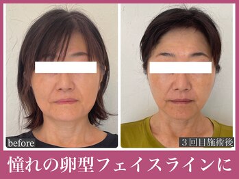 アクアビー(AQUA-B)/