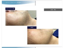 ディシェーレ アスト/ヒゲ脱毛