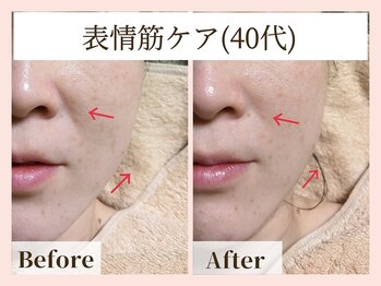 ラーナ(Lana)/リフトアップEMS　before→after