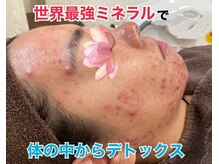 ビエル(Bielle)/強い赤み激ざらつき肌悩みお任せ