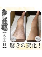 アトレ(Atre)/メンズ足脱毛で新たなスタートへ