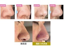 エミット(emit.)/ハイドロフェイシャル