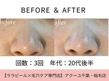 ア クーユ 稲毛店/毛穴洗浄/毛穴の黒ずみ/毛穴レス