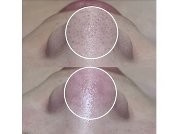 ビオルブ(VIOLVE)/毛穴エクストラクション