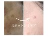 ＼シミケア特化／　スポットシミケア→ 1ヶ所 3,300円