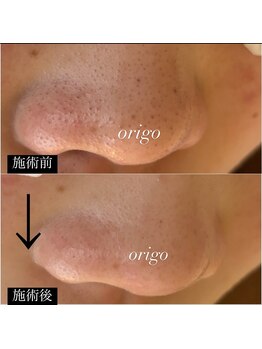 オリーゴ アイラッシュ(origo.eyelash_A/N)/毛穴洗浄