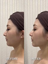 ヴィヴ 三島店(Vive)/《レモンボトル》症例