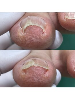 巻き爪補正店 札幌店/【巻き爪補正】